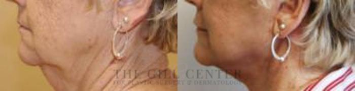Face & Neck Lift Case 406 Before & After Left Side | The Woodlands, TX | The Gill Center for Plastic Surgery and Dermatology