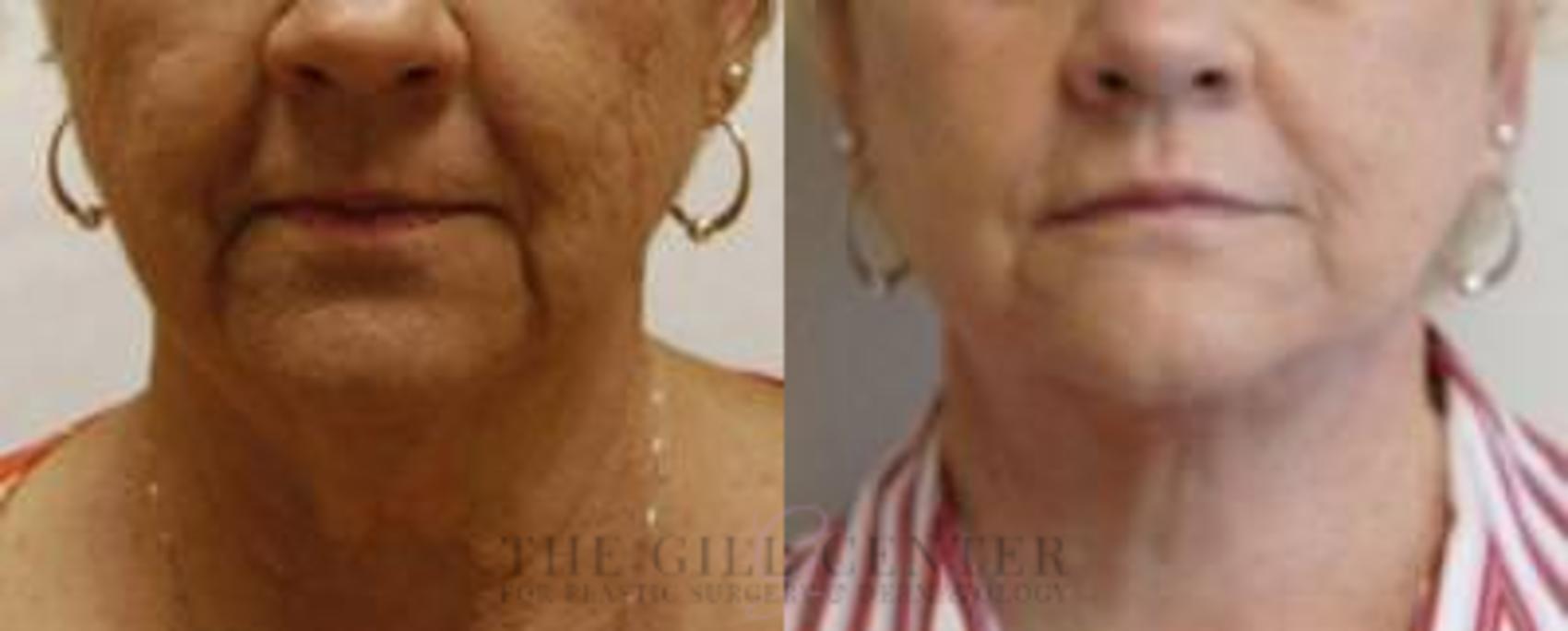 Face & Neck Lift Case 407 Before & After Front | The Woodlands, TX | The Gill Center for Plastic Surgery and Dermatology