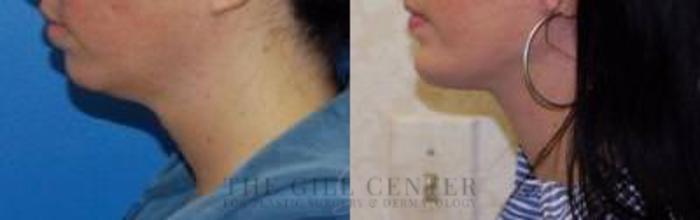 Face & Neck Lift Case 408 Before & After Left Side | The Woodlands, TX | The Gill Center for Plastic Surgery and Dermatology
