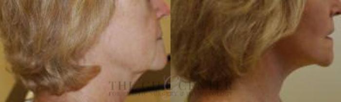 Face & Neck Lift Case 409 Before & After Right Side | The Woodlands, TX | The Gill Center for Plastic Surgery and Dermatology