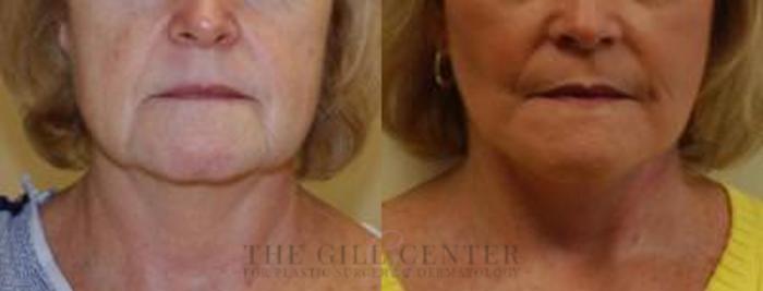 Face & Neck Lift Case 410 Before & After Front | The Woodlands, TX | The Gill Center for Plastic Surgery and Dermatology