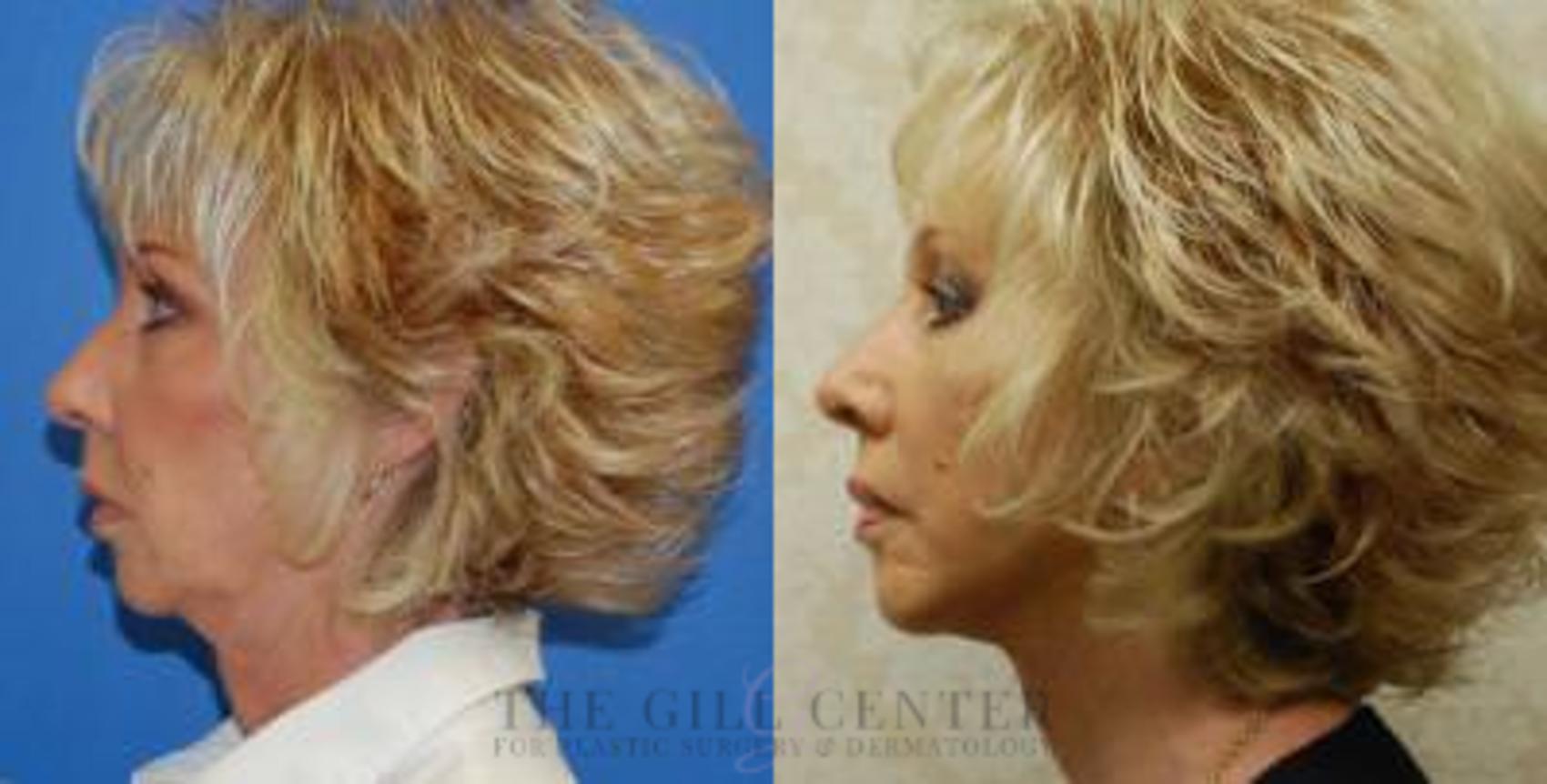 Face & Neck Lift Case 411 Before & After Left Side | The Woodlands, TX | The Gill Center for Plastic Surgery and Dermatology