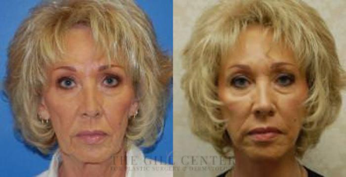 Face & Neck Lift Case 412 Before & After Front | The Woodlands, TX | The Gill Center for Plastic Surgery and Dermatology