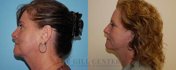 Face & Neck Lift Case 414 Before & After Left Side | The Woodlands, TX | The Gill Center for Plastic Surgery and Dermatology