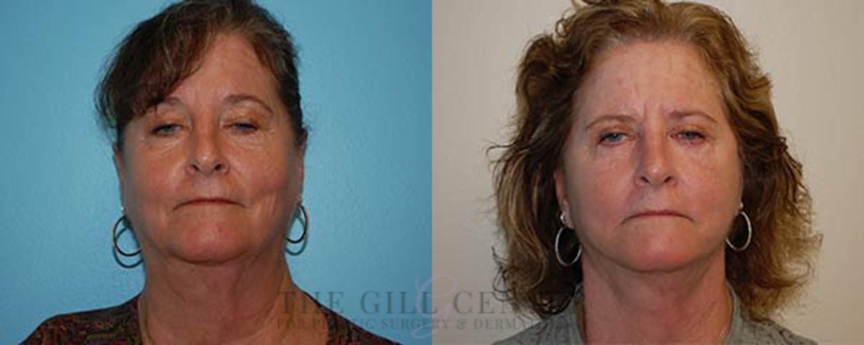 Face & Neck Lift Case 415 Before & After Front | The Woodlands, TX | The Gill Center for Plastic Surgery and Dermatology