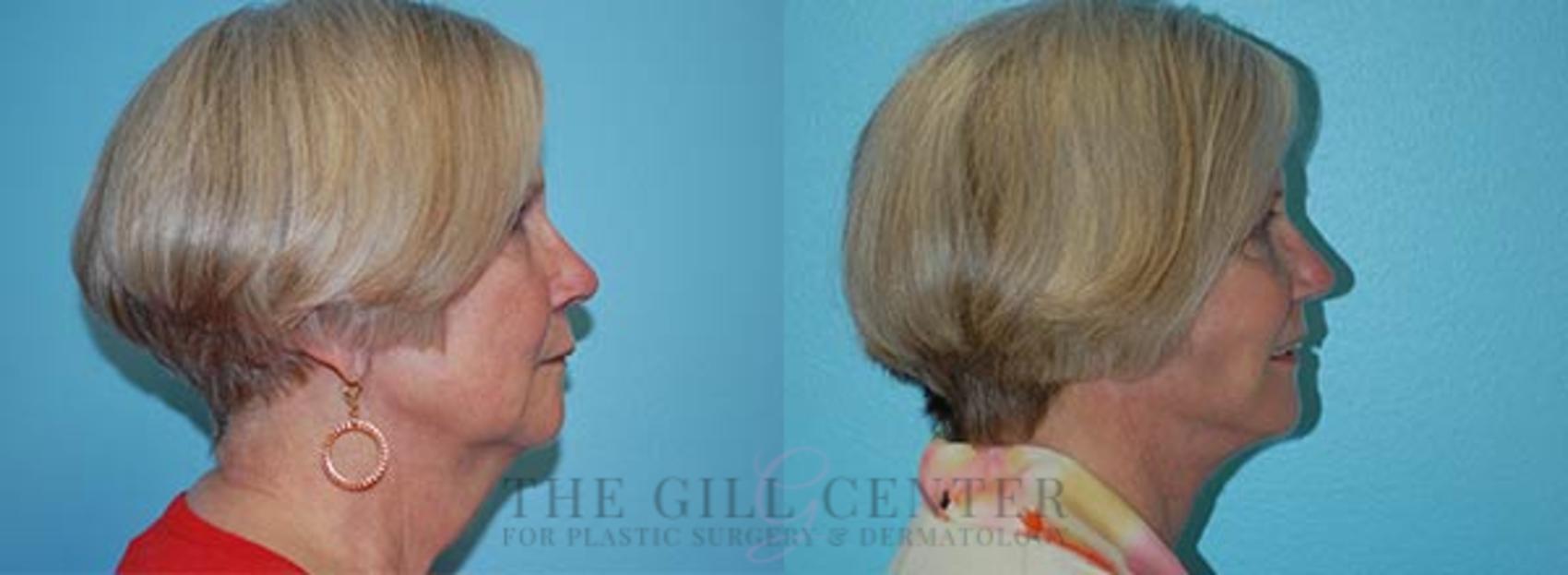 Face & Neck Lift Case 416 Before & After Right Side | The Woodlands, TX | The Gill Center for Plastic Surgery and Dermatology