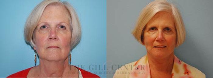 Face & Neck Lift Case 417 Before & After Front | The Woodlands, TX | The Gill Center for Plastic Surgery and Dermatology