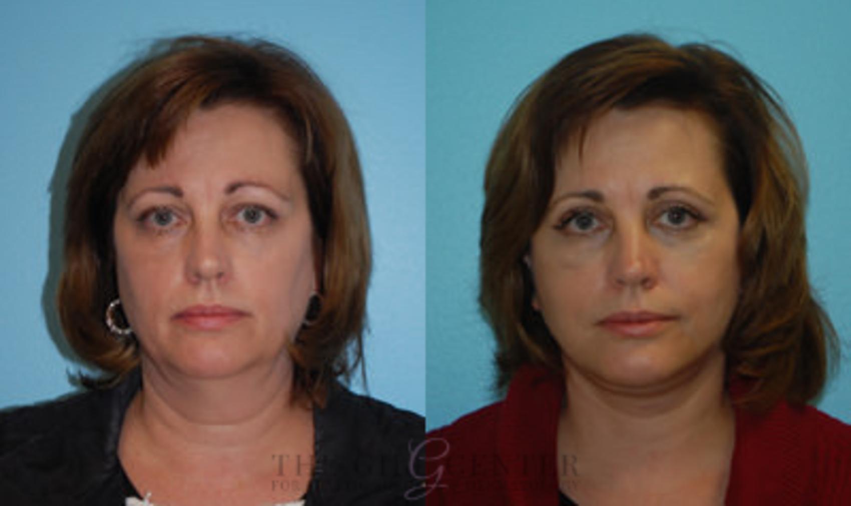 Face & Neck Lift Case 418 Before & After Front | The Woodlands, TX | The Gill Center for Plastic Surgery and Dermatology