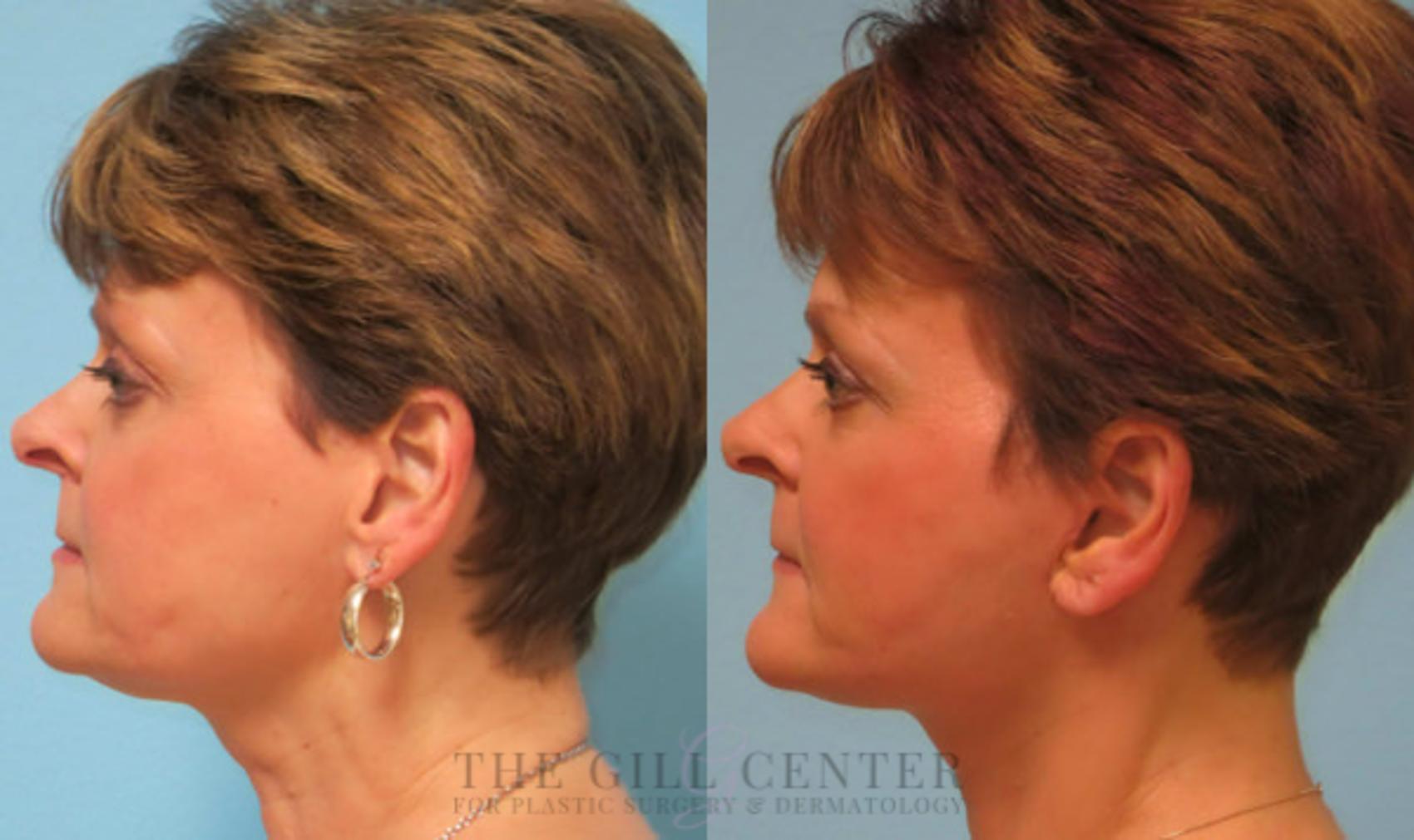 Face & Neck Lift Case 419 Before & After Left Side | The Woodlands, TX | The Gill Center for Plastic Surgery and Dermatology