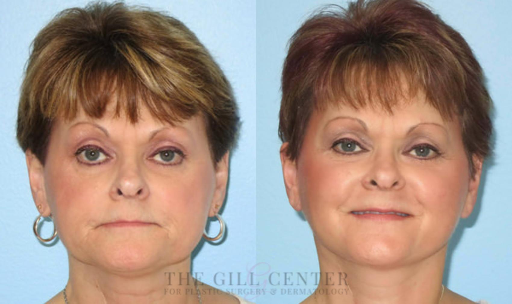 Face & Neck Lift Case 420 Before & After Front | The Woodlands, TX | The Gill Center for Plastic Surgery and Dermatology
