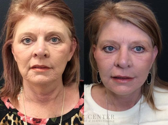 Face & Neck Lift Case 438 Before & After Front | The Woodlands, TX | The Gill Center for Plastic Surgery and Dermatology