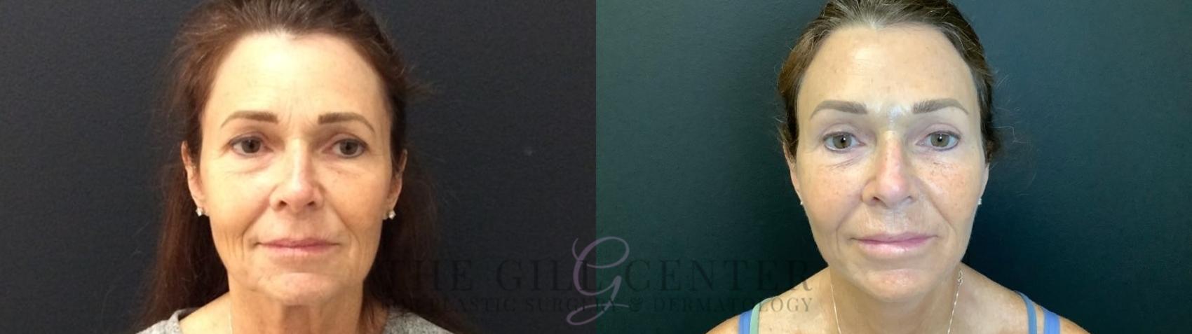 Face & Neck Lift Case 439 Before & After Front | The Woodlands, TX | The Gill Center for Plastic Surgery and Dermatology