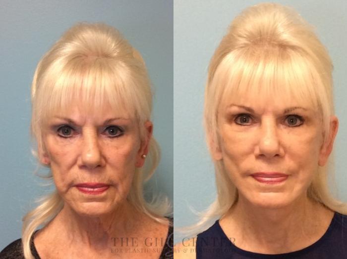 Face & Neck Lift Case 445 Before & After Front | The Woodlands, TX | The Gill Center for Plastic Surgery and Dermatology