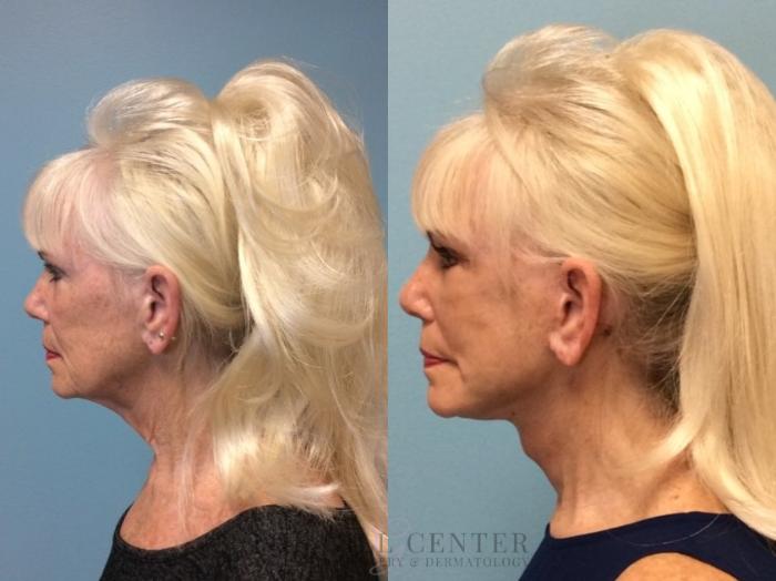 Face & Neck Lift Case 445 Before & After Left Side | The Woodlands, TX | The Gill Center for Plastic Surgery and Dermatology