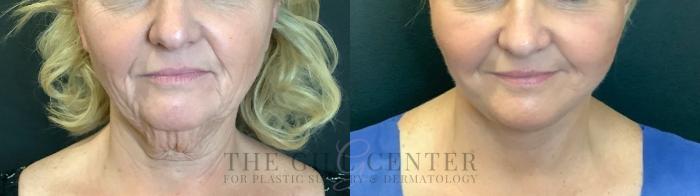 Face & Neck Lift Case 465 Before & After Front | The Woodlands, TX | The Gill Center for Plastic Surgery and Dermatology