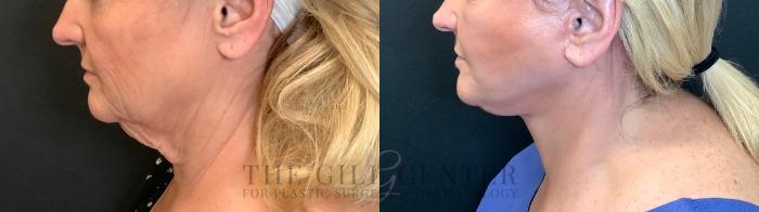Face & Neck Lift Case 465 Before & After Left Side | The Woodlands, TX | The Gill Center for Plastic Surgery and Dermatology