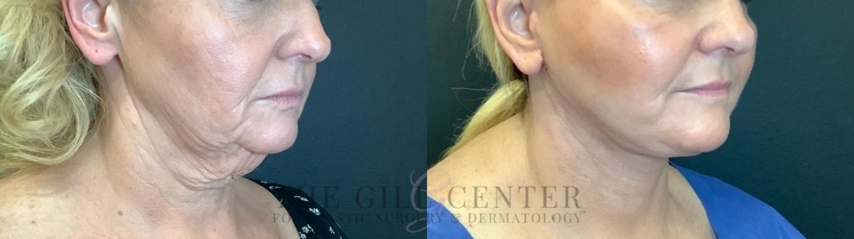Face & Neck Lift Case 465 Before & After Right Side | The Woodlands, TX | The Gill Center for Plastic Surgery and Dermatology