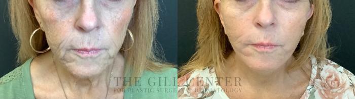 Face & Neck Lift Case 474 Before & After Front | The Woodlands, TX | The Gill Center for Plastic Surgery and Dermatology
