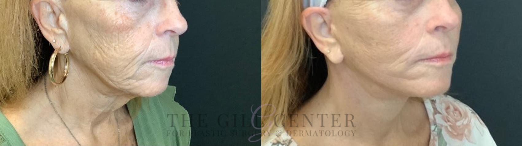 Face & Neck Lift Case 474 Before & After Right Oblique | The Woodlands, TX | The Gill Center for Plastic Surgery and Dermatology