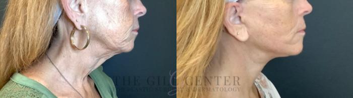 Face & Neck Lift Case 474 Before & After Right Side | The Woodlands, TX | The Gill Center for Plastic Surgery and Dermatology