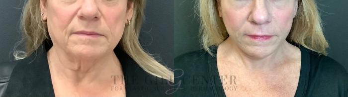 Face & Neck Lift Case 489 Before & After Front | The Woodlands, TX | The Gill Center for Plastic Surgery and Dermatology