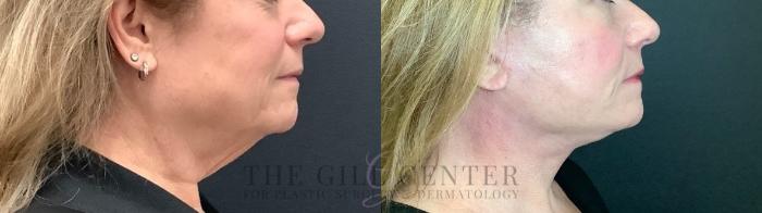 Face & Neck Lift Case 489 Before & After Right Side | The Woodlands, TX | The Gill Center for Plastic Surgery and Dermatology