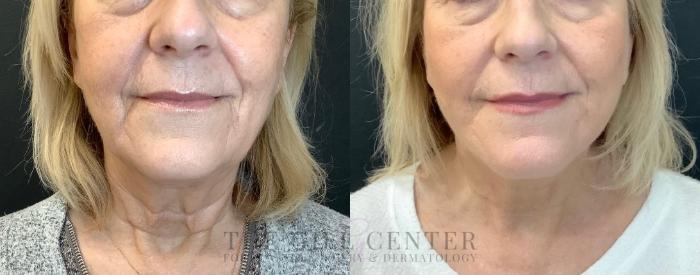Face & Neck Lift Case 503 Before & After Front | The Woodlands, TX | The Gill Center for Plastic Surgery and Dermatology