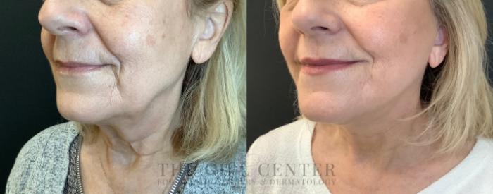 Face & Neck Lift Case 503 Before & After Left Side | The Woodlands, TX | The Gill Center for Plastic Surgery and Dermatology