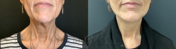 Face & Neck Lift Case 511 Before & After Front | The Woodlands, TX | The Gill Center for Plastic Surgery and Dermatology