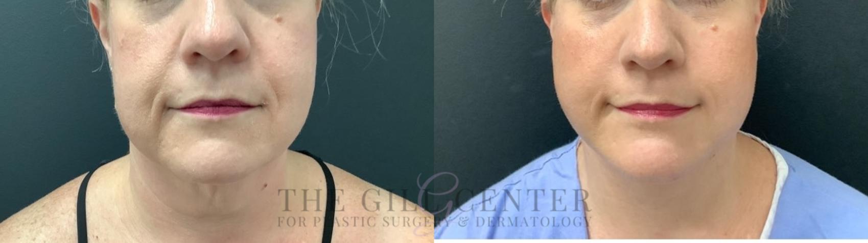 Face & Neck Lift Case 516 Before & After Front | The Woodlands, TX | The Gill Center for Plastic Surgery and Dermatology