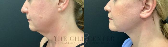 Face & Neck Lift Case 516 Before & After Left Side | The Woodlands, TX | The Gill Center for Plastic Surgery and Dermatology