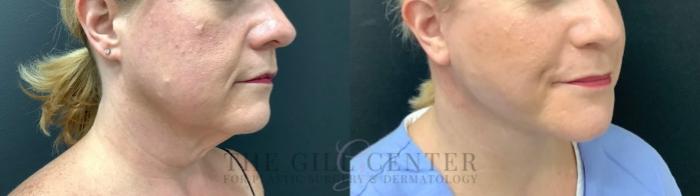 Face & Neck Lift Case 516 Before & After Right Three-quarter view | The Woodlands, TX | The Gill Center for Plastic Surgery and Dermatology