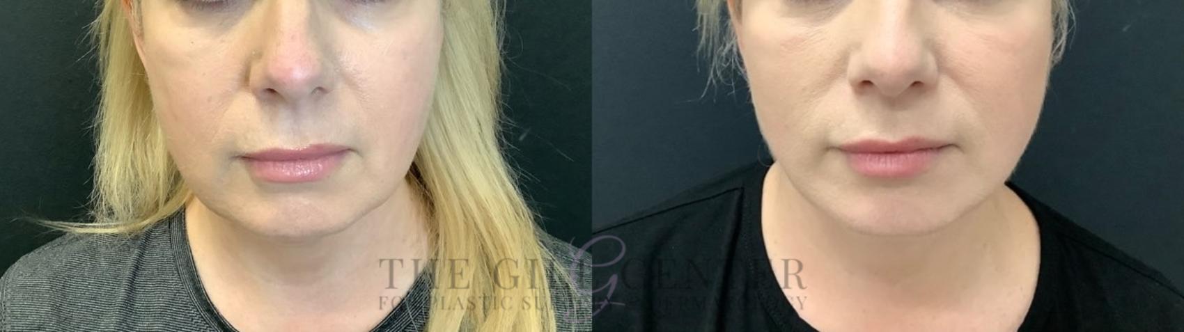 Face & Neck Lift Case 517 Before & After Front | The Woodlands, TX | The Gill Center for Plastic Surgery and Dermatology