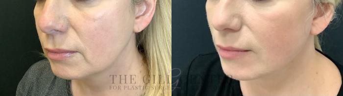Face & Neck Lift Case 517 Before & After Left Three-quarter view | The Woodlands, TX | The Gill Center for Plastic Surgery and Dermatology