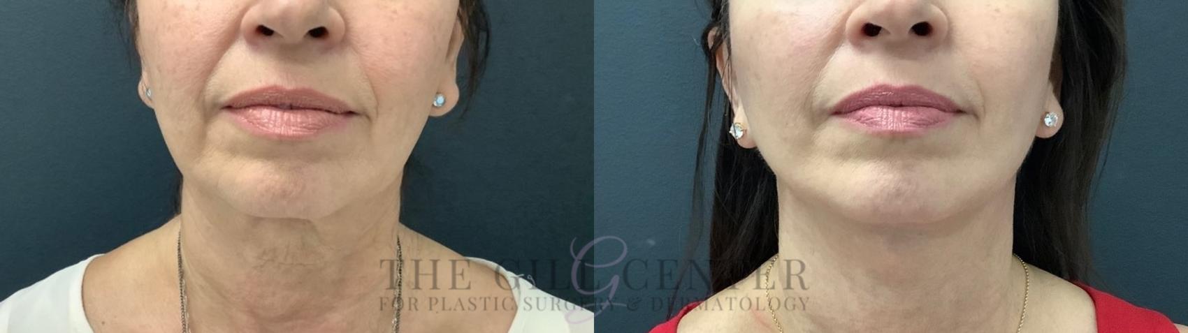 Face & Neck Lift Case 521 Before & After Front | The Woodlands, TX | The Gill Center for Plastic Surgery and Dermatology