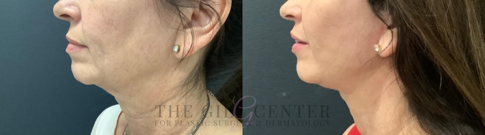 Face & Neck Lift Case 521 Before & After Left Side | The Woodlands, TX | The Gill Center for Plastic Surgery and Dermatology