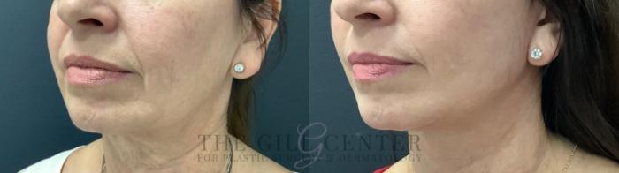 Face & Neck Lift Case 521 Before & After Left Three-quarter view | The Woodlands, TX | The Gill Center for Plastic Surgery and Dermatology