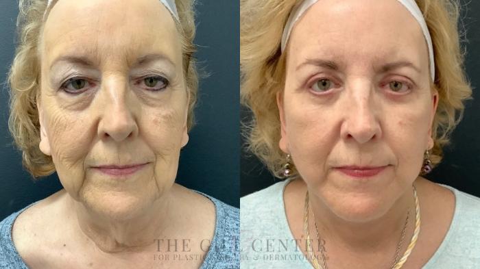 Face & Neck Lift Case 533 Before & After Front | The Woodlands, TX | The Gill Center for Plastic Surgery and Dermatology