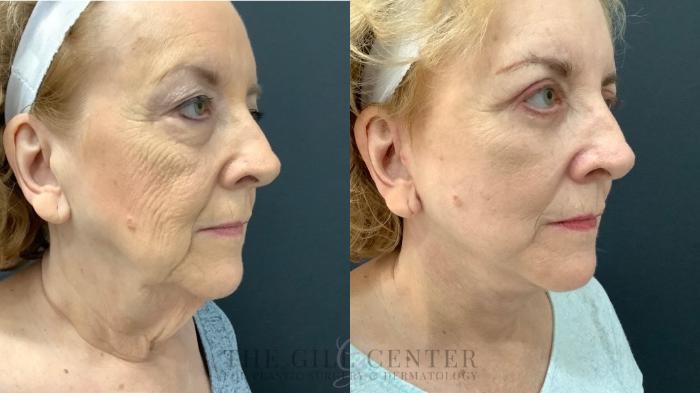 Face & Neck Lift Case 533 Before & After Right Side | The Woodlands, TX | The Gill Center for Plastic Surgery and Dermatology