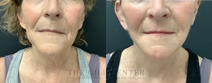 Face & Neck Lift Case 564 Before & After Front | The Woodlands, TX | The Gill Center for Plastic Surgery and Dermatology
