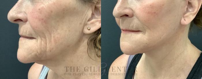 Face & Neck Lift Case 564 Before & After Left Oblique | The Woodlands, TX | The Gill Center for Plastic Surgery and Dermatology