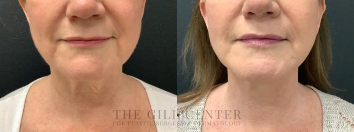 Face & Neck Lift Case 577 Before & After Front | The Woodlands, TX | The Gill Center for Plastic Surgery and Dermatology