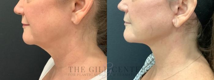Face & Neck Lift Case 577 Before & After Left Side | The Woodlands, TX | The Gill Center for Plastic Surgery and Dermatology