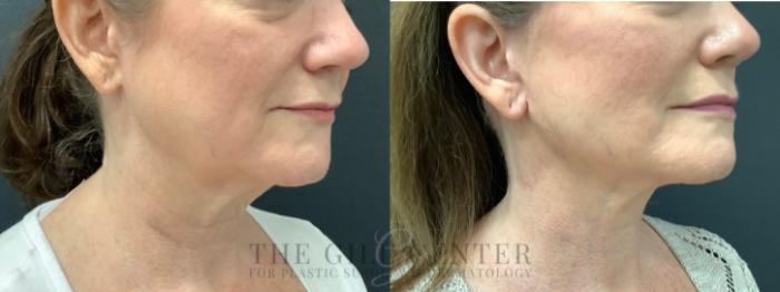 Face & Neck Lift Case 577 Before & After Right Oblique | The Woodlands, TX | The Gill Center for Plastic Surgery and Dermatology