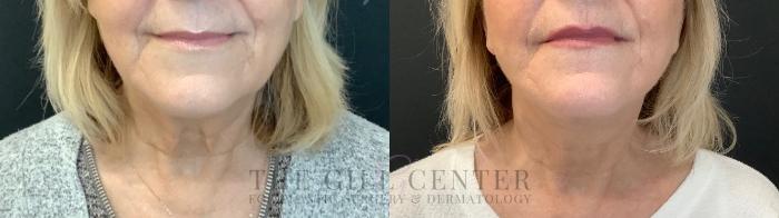 Face & Neck Lift Case 593 Before & After Front | The Woodlands, TX | The Gill Center for Plastic Surgery and Dermatology