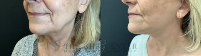 Face & Neck Lift Case 593 Before & After Left Oblique | The Woodlands, TX | The Gill Center for Plastic Surgery and Dermatology
