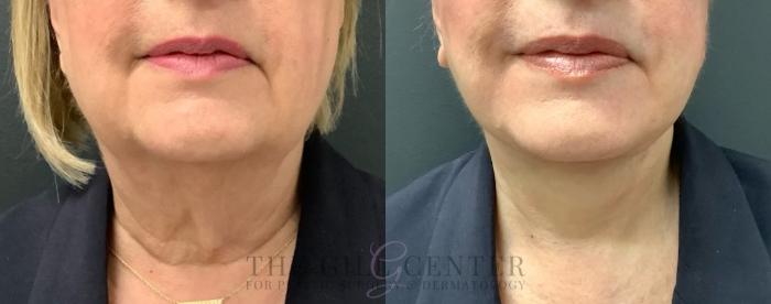 Face & Neck Lift Case 626 Before & After Front | The Woodlands, TX | The Gill Center for Plastic Surgery and Dermatology