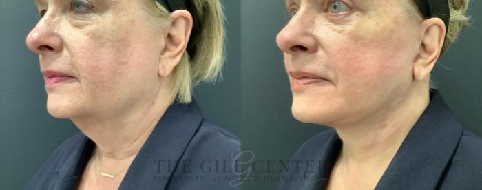 Face & Neck Lift Case 626 Before & After Left Oblique | The Woodlands, TX | The Gill Center for Plastic Surgery and Dermatology