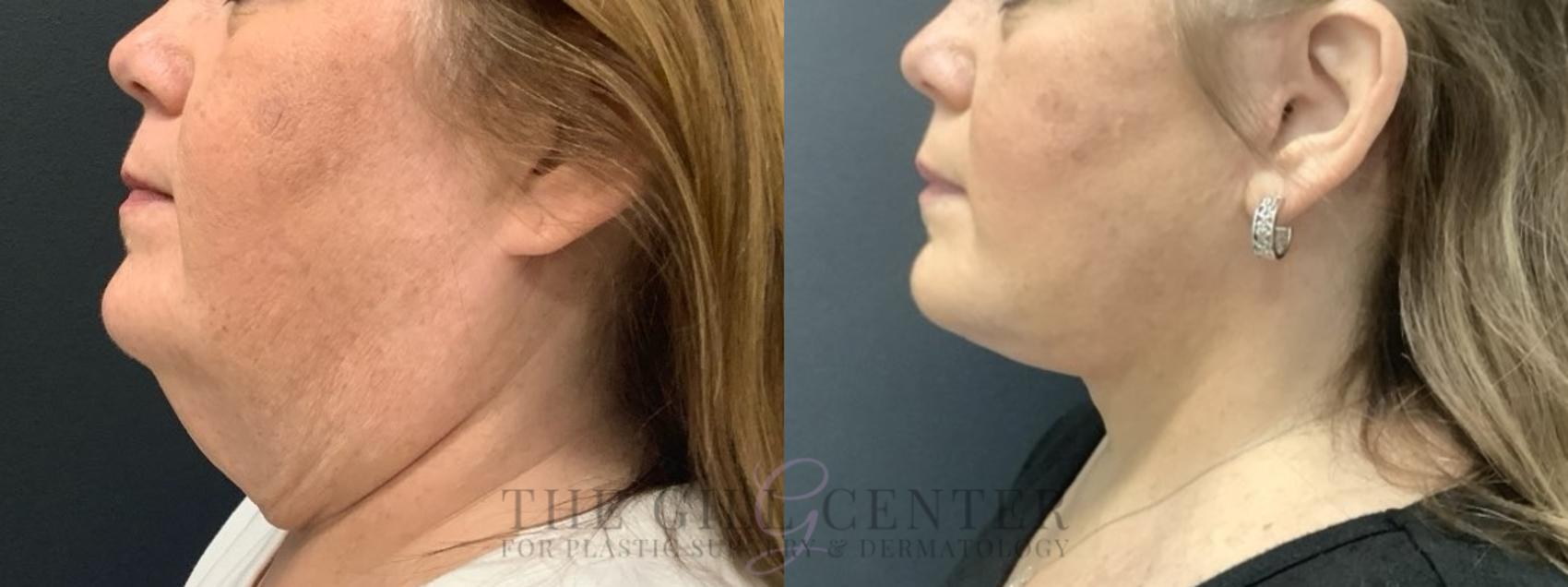 Face & Neck Lift Case 670 Before & After Left Side | The Woodlands, TX | The Gill Center for Plastic Surgery and Dermatology
