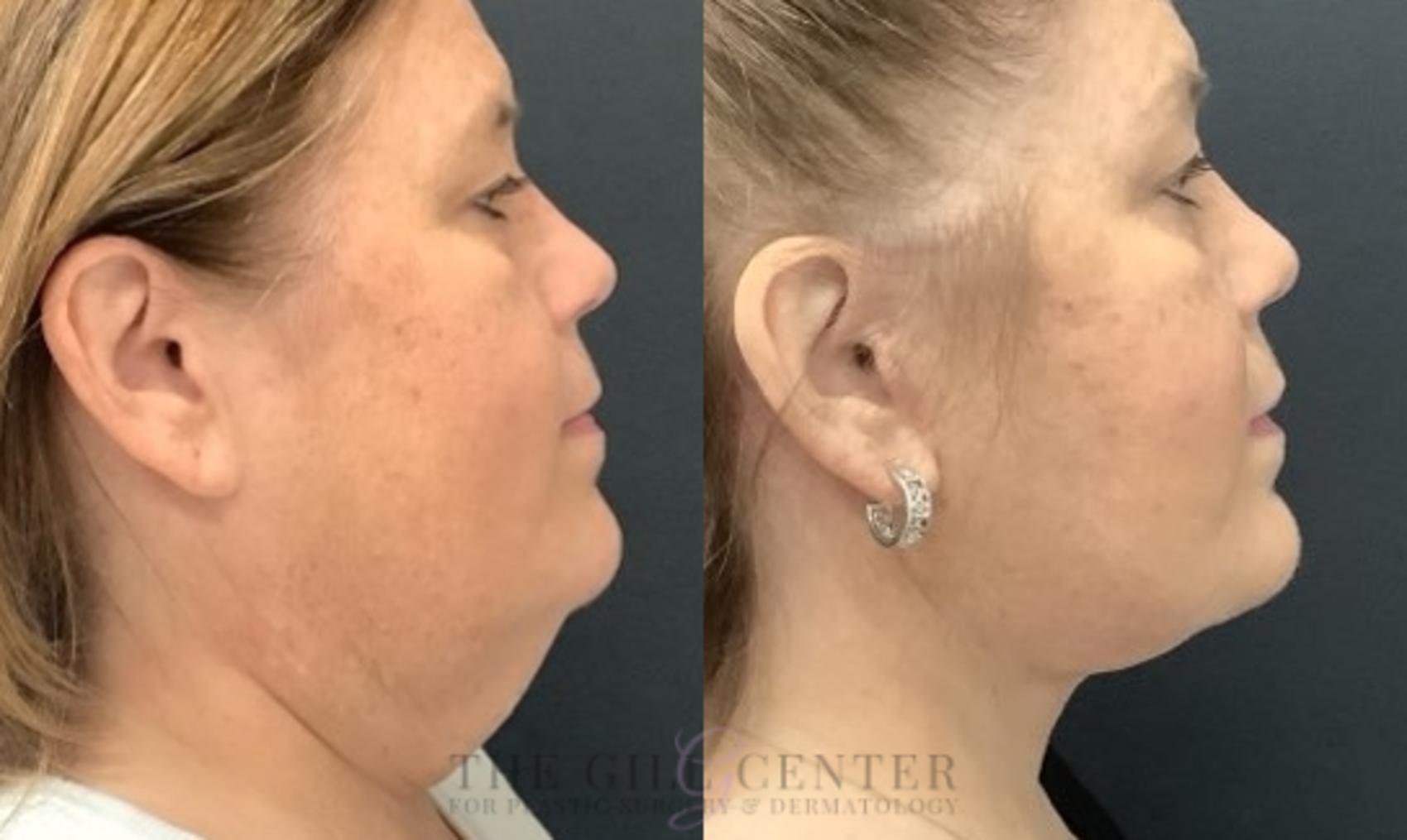 Face & Neck Lift Case 670 Before & After Right Side | The Woodlands, TX | The Gill Center for Plastic Surgery and Dermatology